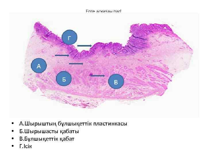 Ерте асқазан рагі • • А. Шырыштың бұлшықеттік пластинкасы Б. Шырышасты қабаты В. Бұлшықеттік