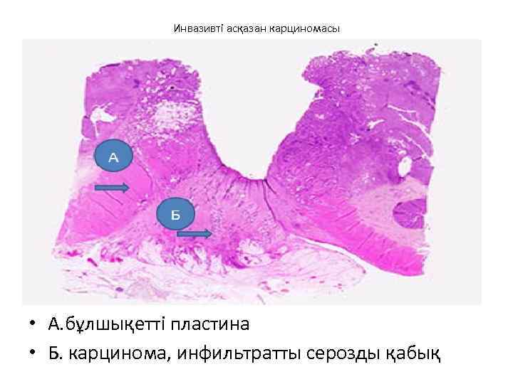 Инвазивті асқазан карциномасы • А. бұлшықетті пластина • Б. карцинома, инфильтратты серозды қабық 