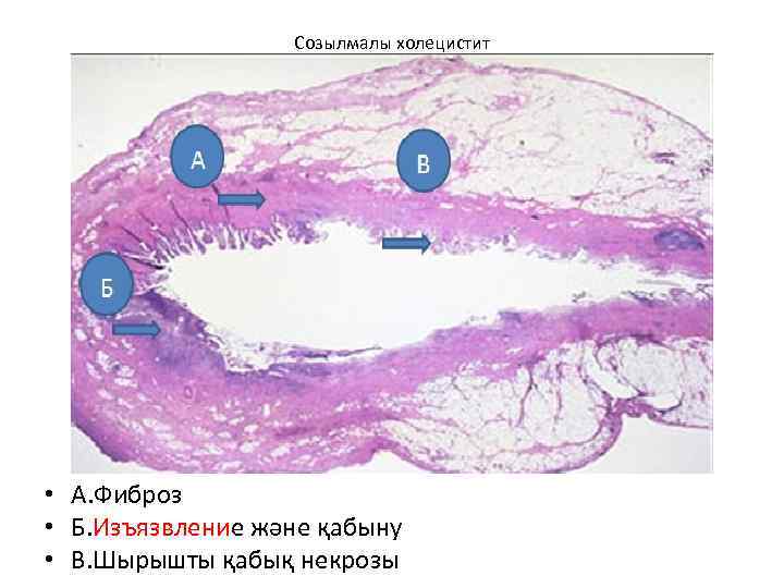 Созылмалы холецистит • А. Фиброз • Б. Изъязвление және қабыну • В. Шырышты қабық