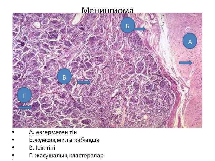 Менингиома • • • А. өзгермеген тін Б. жұмсақ милы қабықша В. Ісік тіні