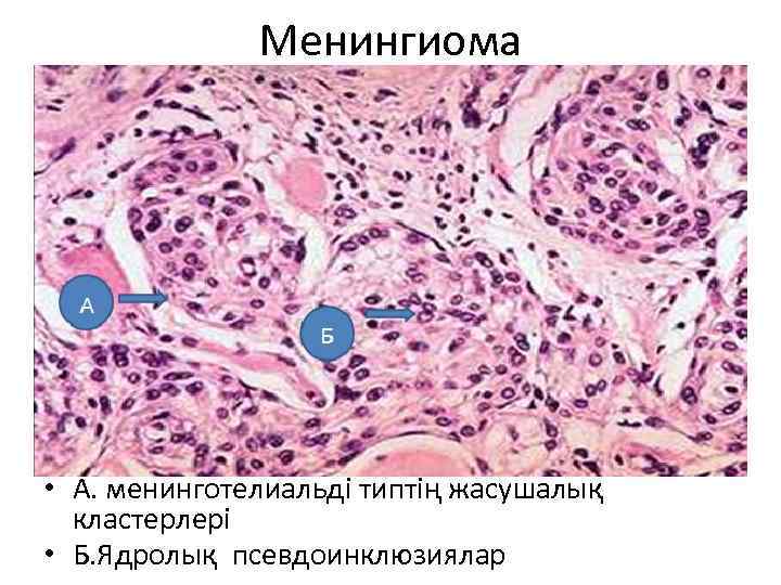 Менингиома • А. менинготелиальді типтің жасушалық кластерлері • Б. Ядролық псевдоинклюзиялар 