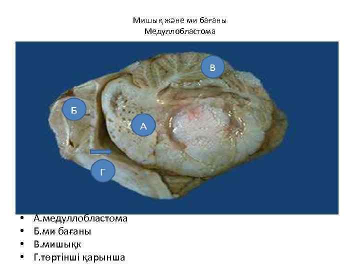 Мишық және ми бағаны Медуллобластома • • А. медуллобластома Б. ми бағаны В. мишықк