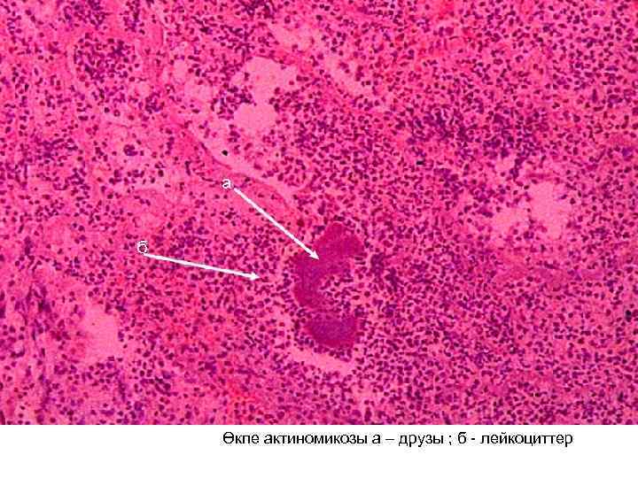 Өкпе актиномикозы а – друзы ; б - лейкоциттер 