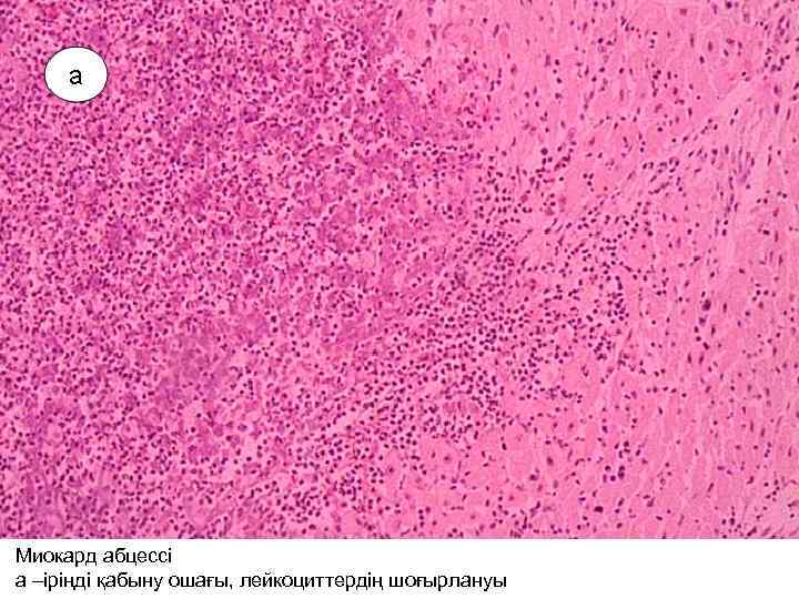 Миокард абцессі а –іріңді қабыну ошағы, лейкоциттердің шоғырлануы 