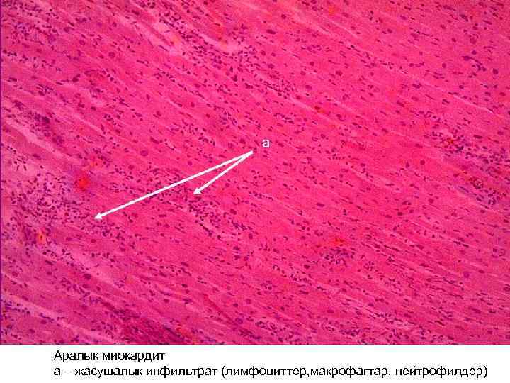 Аралық миокардит а – жасушалық инфильтрат (лимфоциттер, макрофагтар, нейтрофилдер) 