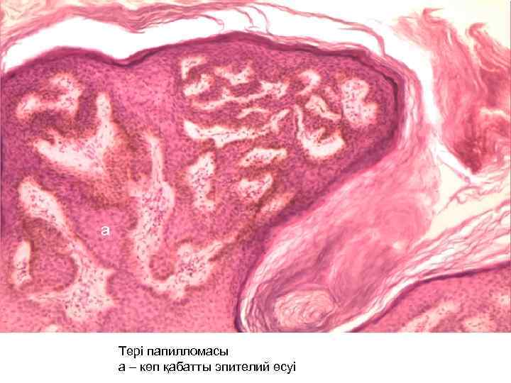Тері папилломасы а – көп қабатты эпителий өсуі 