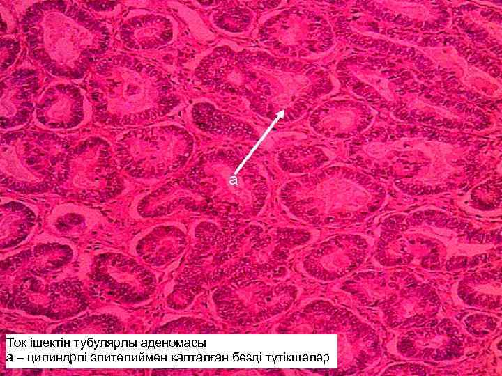 Тоқ ішектің тубулярлы аденомасы а – цилиндрлі эпителиймен қапталған безді түтікшелер 