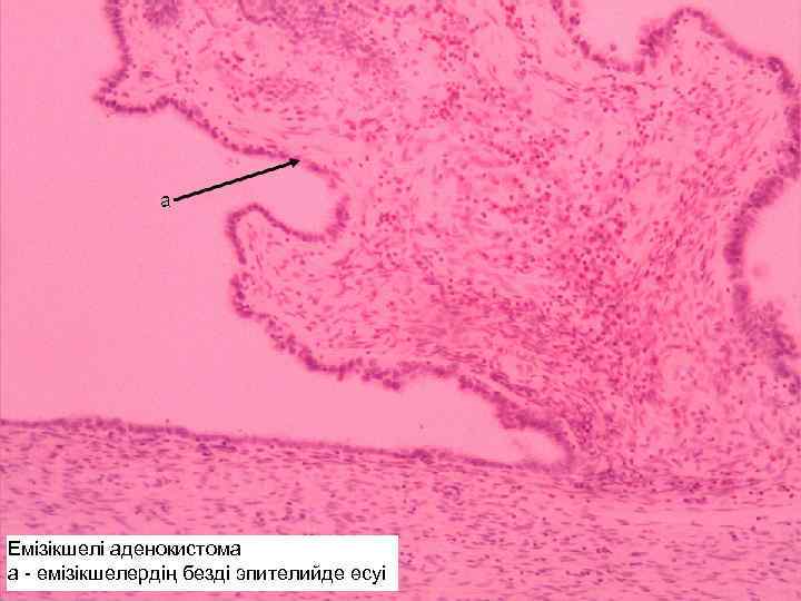 Емізікшелі аденокистома а - емізікшелердің безді эпителийде өсуі 