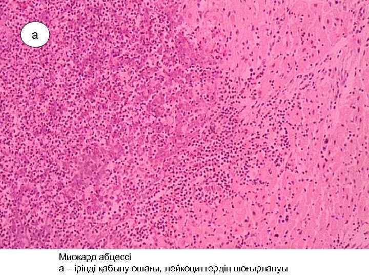 Миокард абцессі а – іріңді қабыну ошағы, лейкоциттердің шоғырлануы 