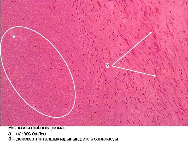 Некрозды фибросаркома а – некроз ошағы б – дәнекер тін талшықтарының ретсіз орналасуы 
