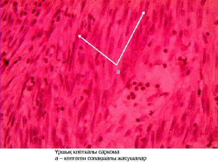 Ұршық клеткалы саркома а – көптеген сопақшалы жасушалар 