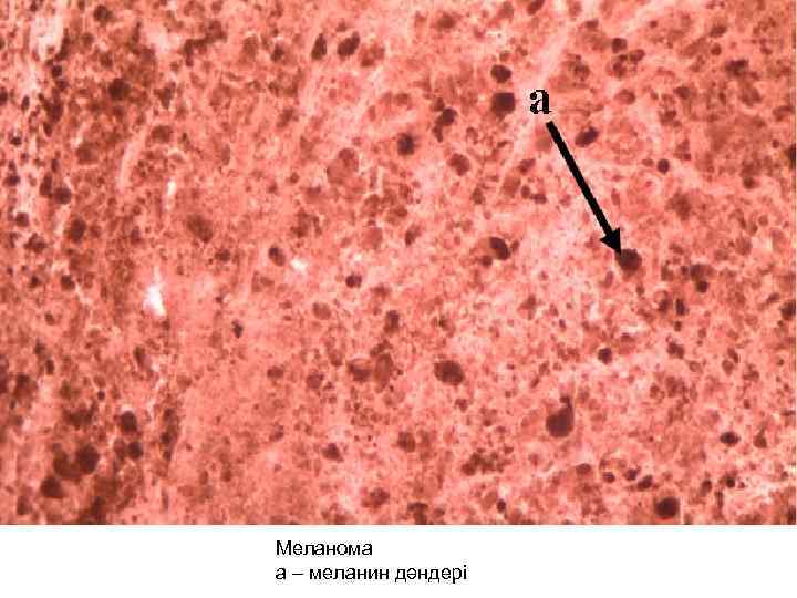 Меланома а – меланин дәндері 