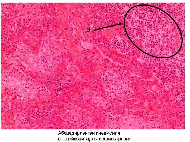 Абсцедирленген пневмония а – лейкоцитарлы инфильтрация 