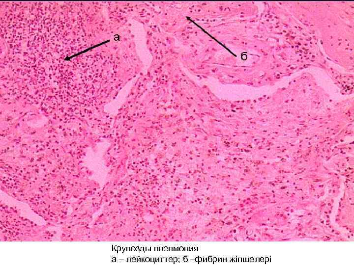 Крупозды пневмония а – лейкоциттер; б –фибрин жіпшелері 