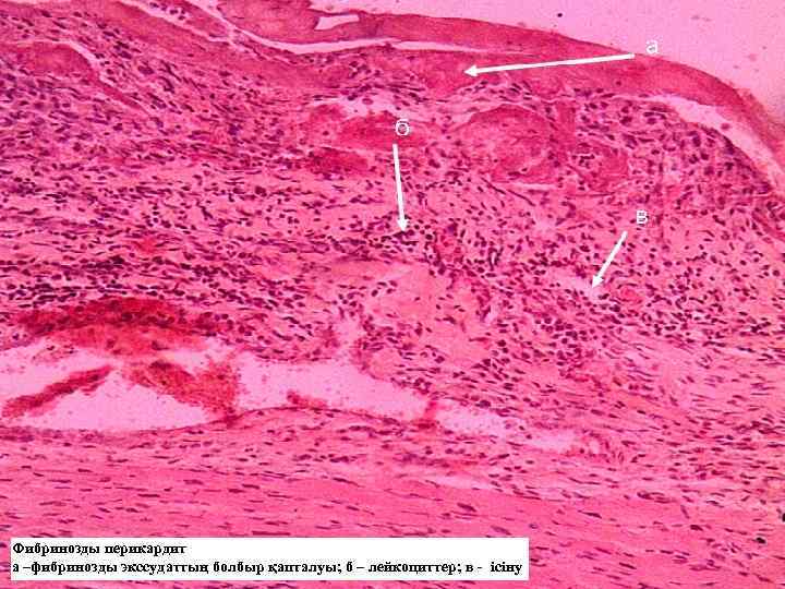 Фибринозды перикардит а –фибринозды экссудаттың болбыр қапталуы; б – лейкоциттер; в - ісіну 
