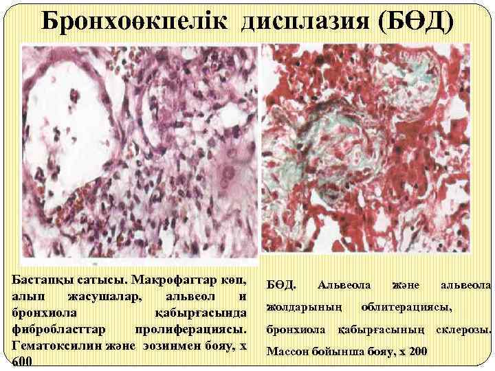 Бронхолегочная дисплазия тест нмо