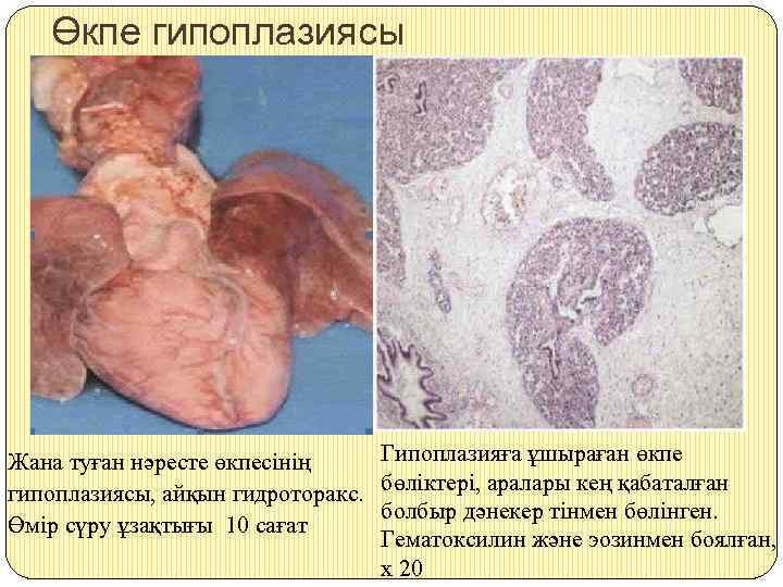 Өкпе гипоплазиясы Гипоплазияға ұшыраған өкпе Жана туған нәресте өкпесінің гипоплазиясы, айқын гидроторакс. бөліктері, аралары