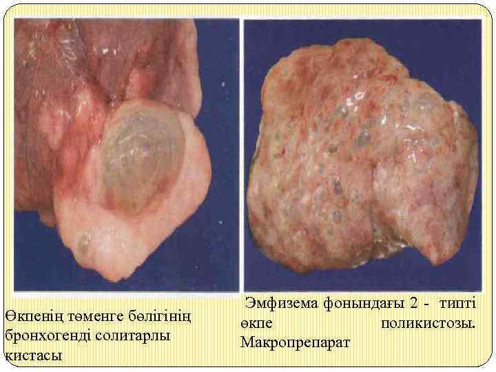 Өкпенің төменге бөлігінің бронхогенді солитарлы кистасы Эмфизема фонындағы 2 - типті өкпе поликистозы. Макропрепарат