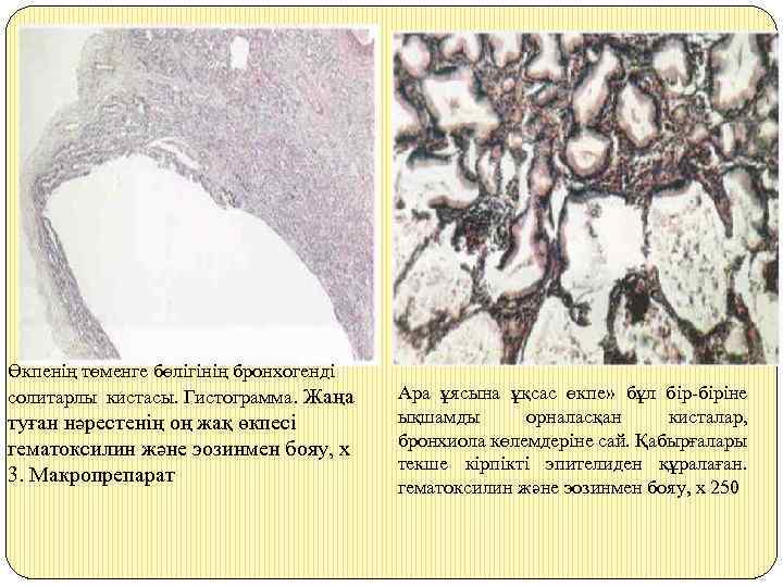 Өкпенің төменге бөлігінің бронхогенді солитарлы кистасы. Гистограмма. Жаңа туған нәрестенің оң жақ өкпесі гематоксилин