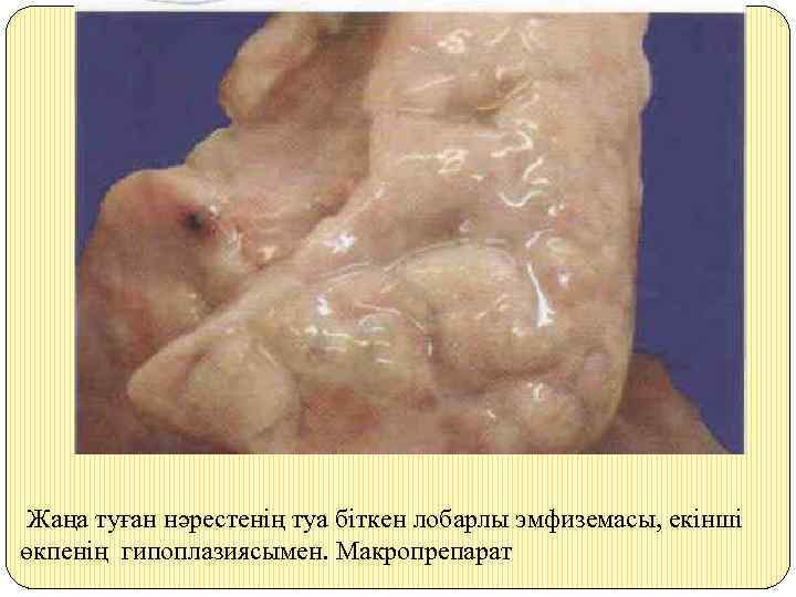 Жаңа туған нәрестенің туа біткен лобарлы эмфиземасы, екінші өкпенің гипоплазиясымен. Макропрепарат 