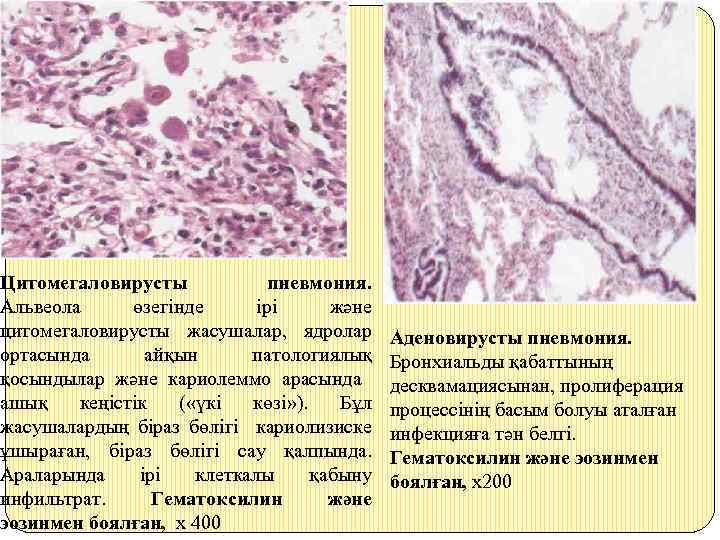 Цитомегаловирусты пневмония. Альвеола өзегінде ірі және цитомегаловирусты жасушалар, ядролар ортасында айқын патологиялық қосындылар және
