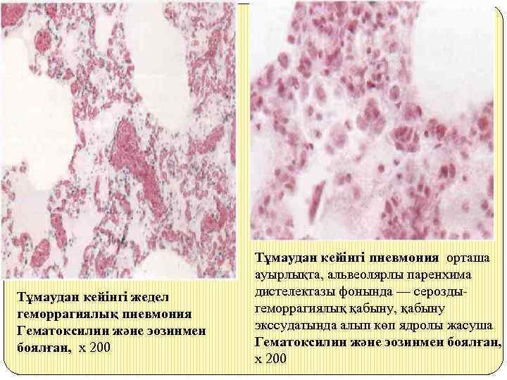 Тұмаудан кейінгі жедел геморрагиялық пневмония Гематоксилин және эозинмен боялған, х 200 Тұмаудан кейінгі пневмония