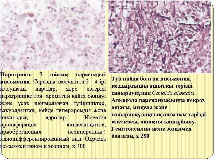 Парагрипп. 3 айлық нәрестедегі пневмония. Серозды экссудатта 2— 4 -ірі жасушалы ядралар, ядро өзгерісі