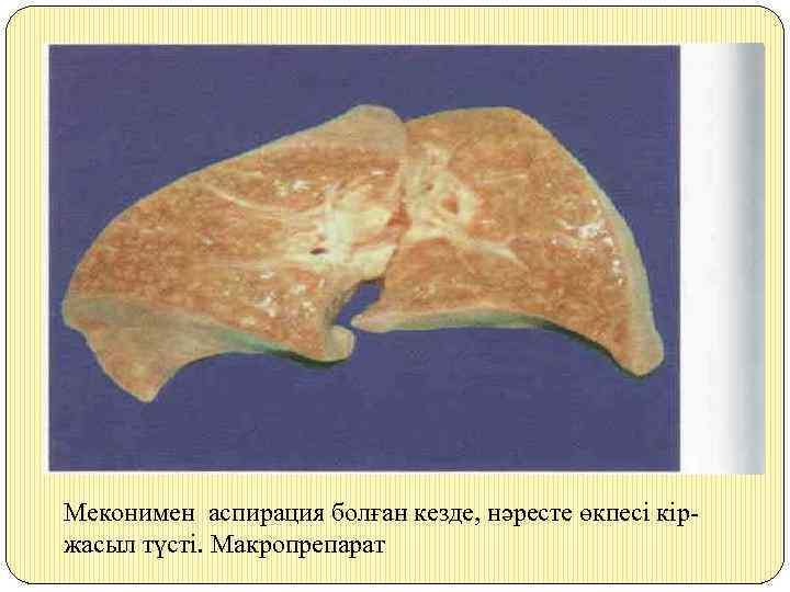 Меконимен аспирация болған кезде, нәресте өкпесі кіржасыл түсті. Макропрепарат 