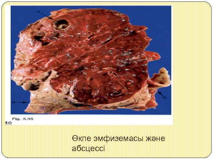 Өкпе эмфиземасы және абсцессі 