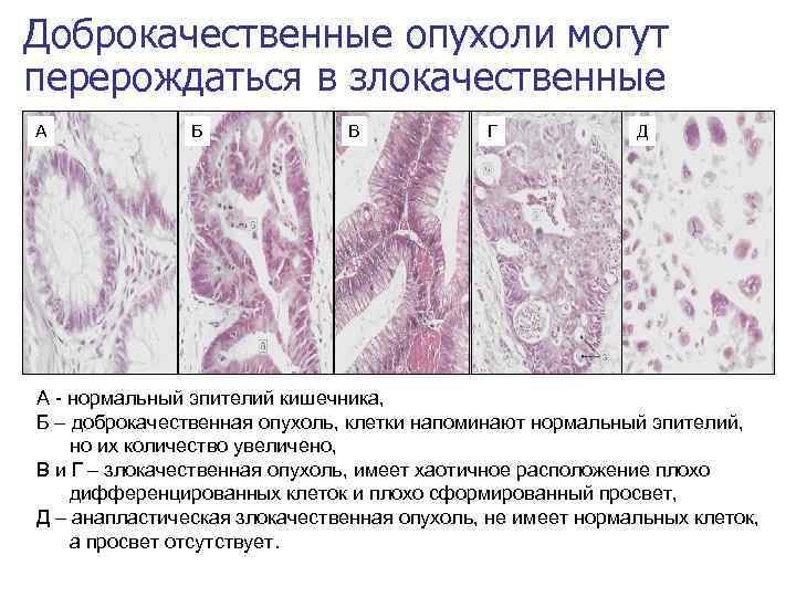 Доброкачественные и злокачественные опухоли