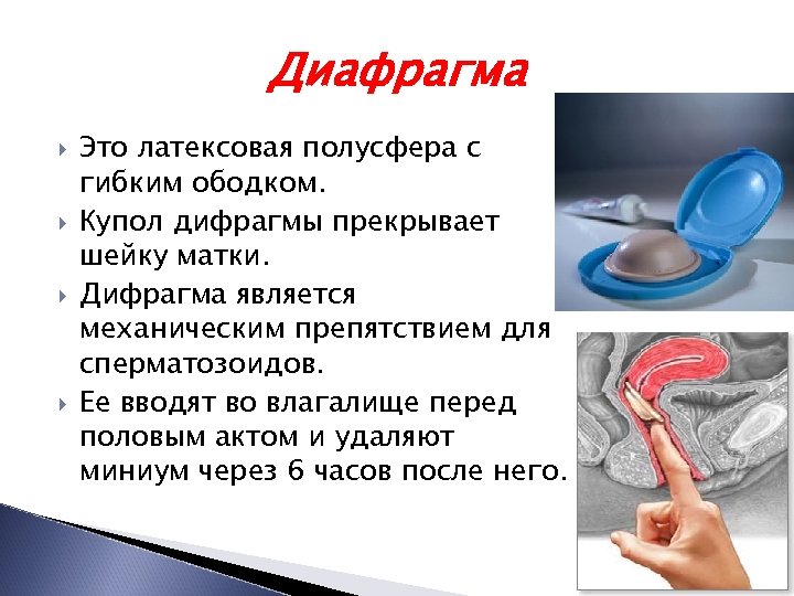 Диафрагма Это латексовая полусфера с гибким ободком. Купол дифрагмы прекрывает шейку матки. Дифрагма является