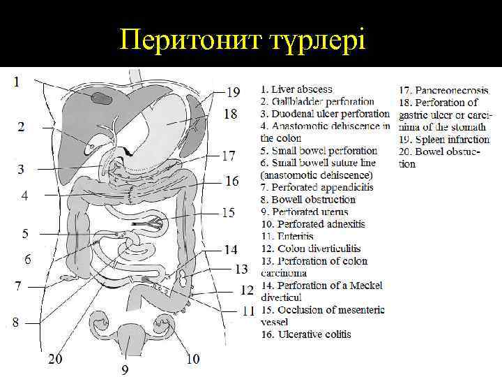 Перитонит түрлері 