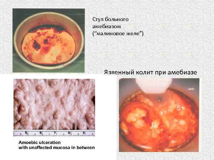 Стул больного амебиазом (“малиновое желе”) Язвенный колит при амебиазе 