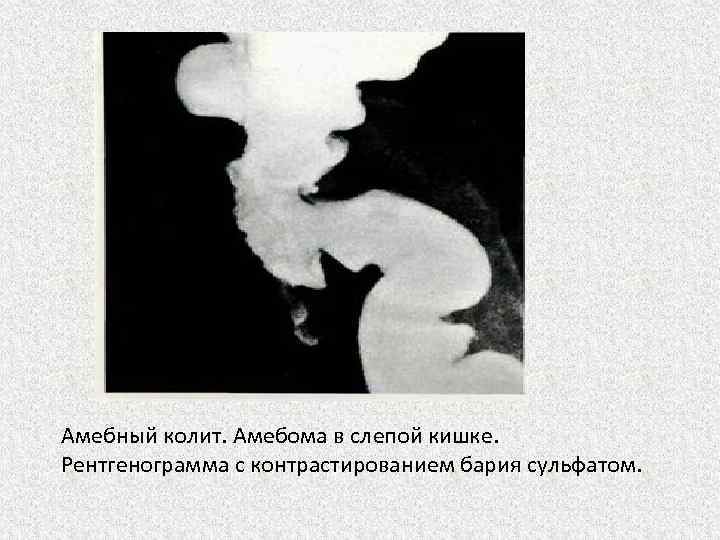 Амебный колит. Амебома в слепой кишке. Рентгенограмма с контрастированием бария сульфатом. 