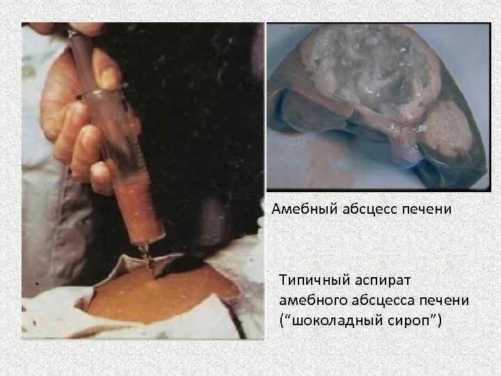 Амебный абсцесс печени Типичный аспират амебного абсцесса печени (“шоколадный сироп”) 