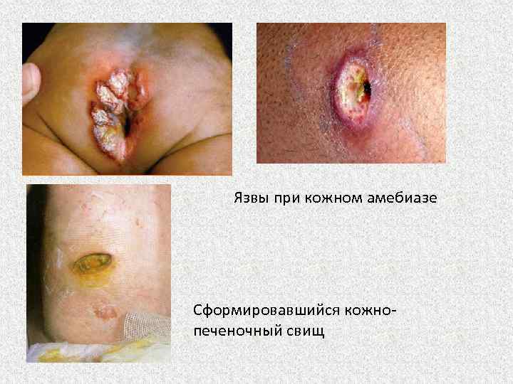 Язвы при кожном амебиазе Сформировавшийся кожнопеченочный свищ 