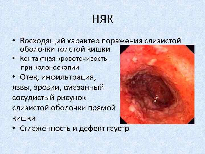 НЯК • Восходящий характер поражения слизистой оболочки толстой кишки • Контактная кровоточивость при колоноскопии