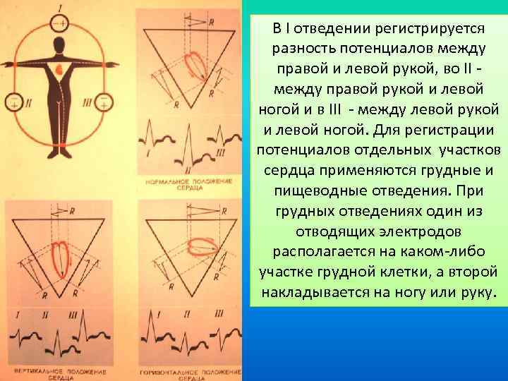 В I отведении регистрируется разность потенциалов между правой и левой рукой, во II -