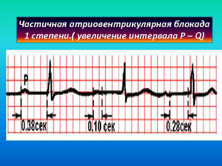 Частичная атриовентрикулярная блокада 1 степени. ( увеличение интервала P – Q) 