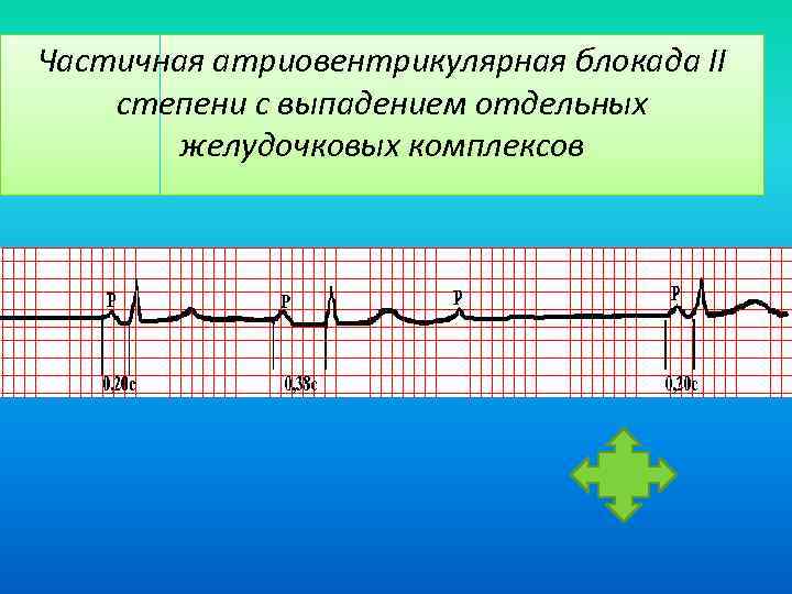 Частичная атриовентрикулярная блокада II степени с выпадением отдельных желудочковых комплексов 