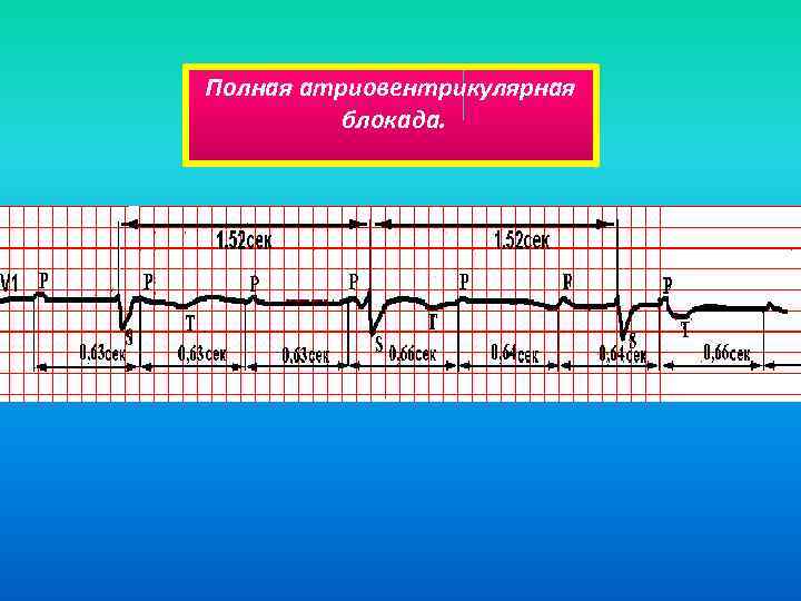 Полная атриовентрикулярная блокада. 
