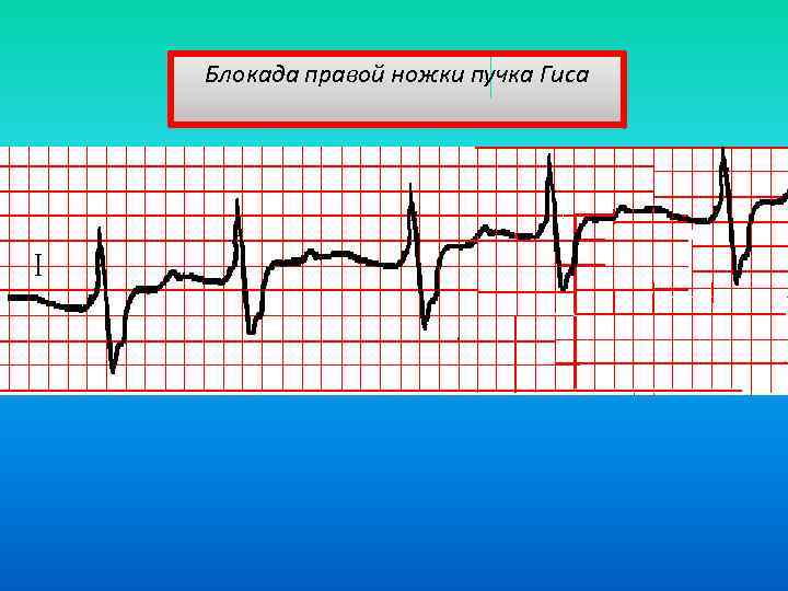 Блокада правой ножки пучка Гиса 