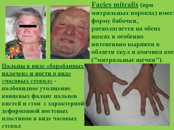 Facies mitralis (при Пальцы в виде «барабанных палочек» и ногти в виде «часовых стекол»