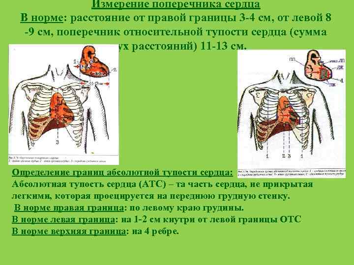 Правая граница относительной тупости образована