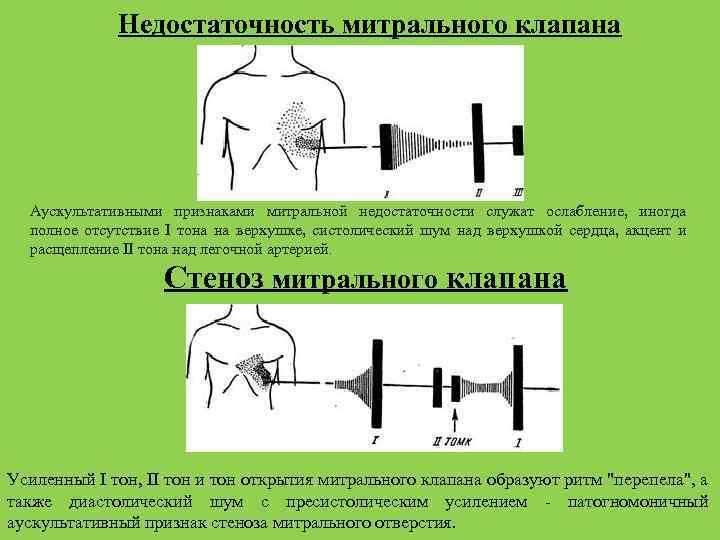 Недостаточность митрального клапана Аускультативными признаками митральной недостаточности служат ослабление, иногда полное отсутствие I тона