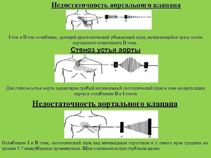 Недостаточность аортального клапана I тон и II тон ослаблены, дующий диастолический убывающий шум, начинающийся