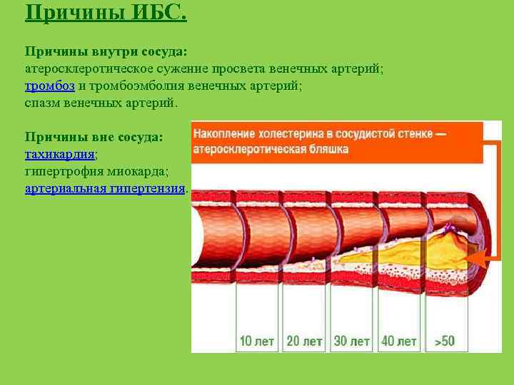 Причины ИБС. Причины внутри сосуда: атеросклеротическое сужение просвета венечных артерий; тромбоз и тромбоэмболия венечных