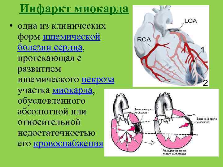 Виды инфаркта. Инфаркт миокарда одна из клинических. Кровоснабжение миокарда. Инфаркт миокарда семиотика.