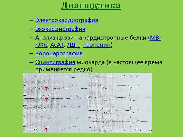 Диагностика – Электрокардиография – Эхокардиография – Анализ крови на кардиотропные белки (MBКФК, Ас. АТ,