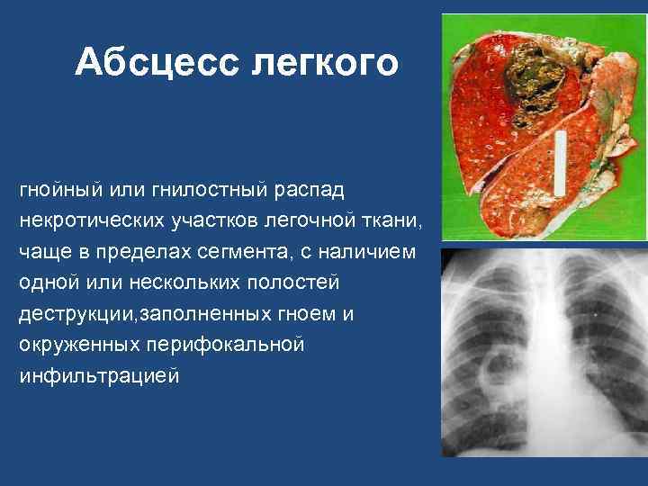 Абсцесс легкого гнойный или гнилостный распад некротических участков легочной ткани, чаще в пределах сегмента,